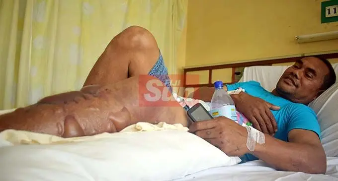 “Hero” driver Rupeni Siganisucu recovering at the Lautoka Hospital on November 28, 2019. He is still unable to walk.  Photo: Salote Qalubau