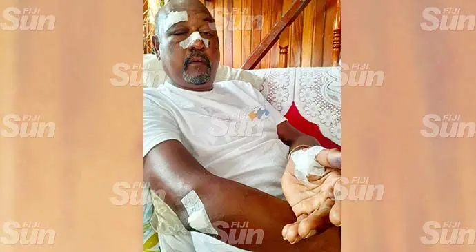 Taxi driver Suraj Nath recovering at home after he was robbed and assaulted by three youths in Pacific Harbour on October 16, 2021. Photo: Ronald Kumar
