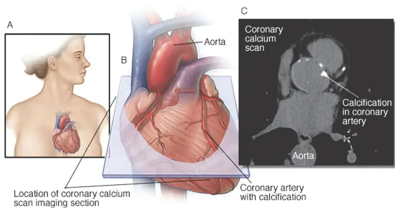 Know your heart disease risk with a calcium score test