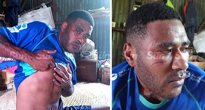 Inoke Tuinamata showing the visible marks on his body after alleging Police brutality. Photo: Josefa Babitu