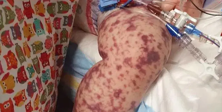 Meningococcal disease. Photo: Sydney Morning Herald