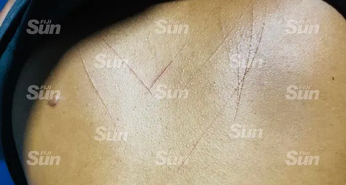Scars on Mereseini Nabou’s back.  Photo: Wati Talebula