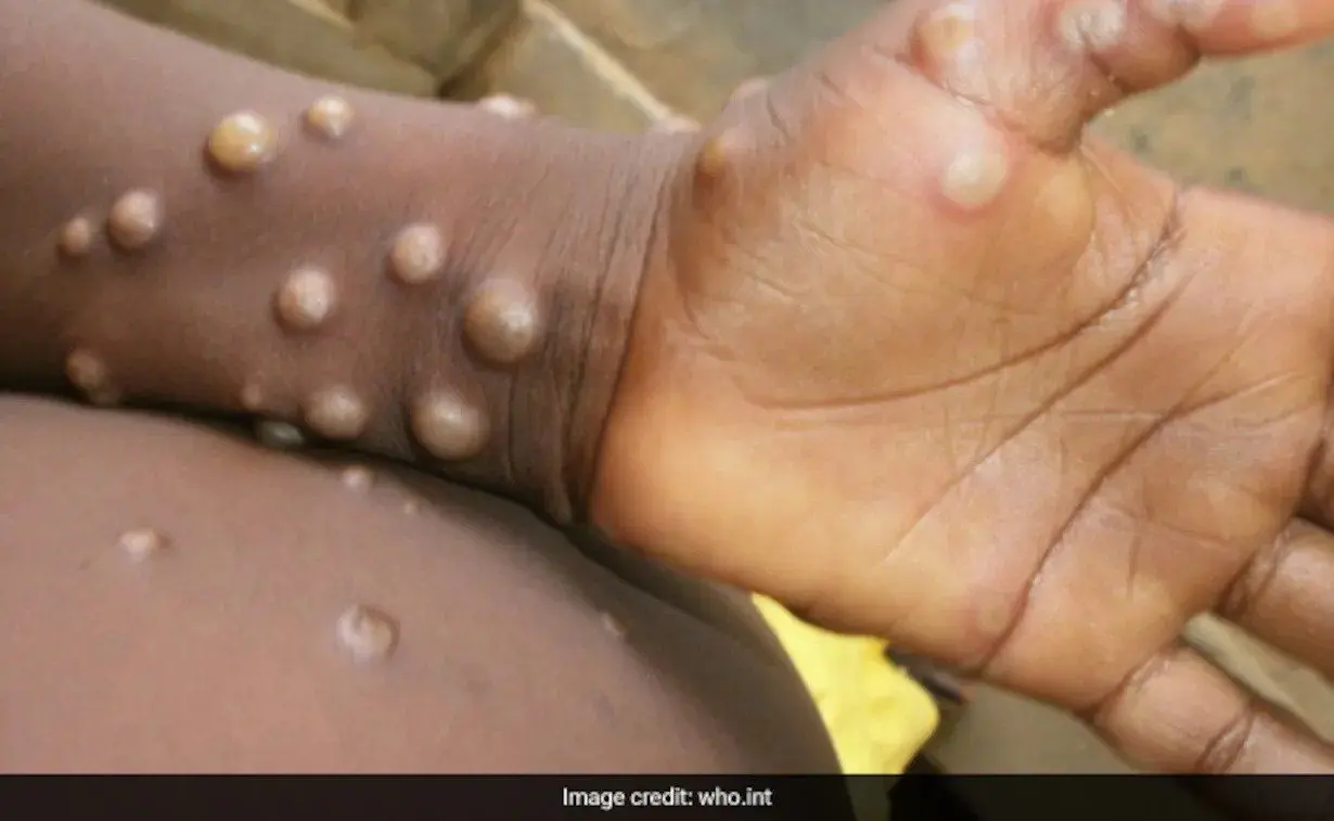 Monkeypox