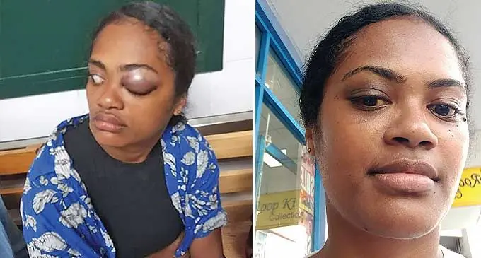 Pictured left: Ms Dileqa with her injured eye. Right: Kinisimere Dileqa after recovering from an injured eye. 