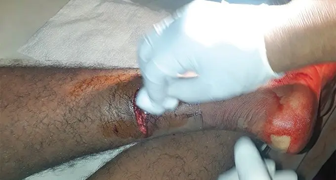 Sagar Lal’s son, Rynal, was bitten last week in Navosai Road in Nasinu.