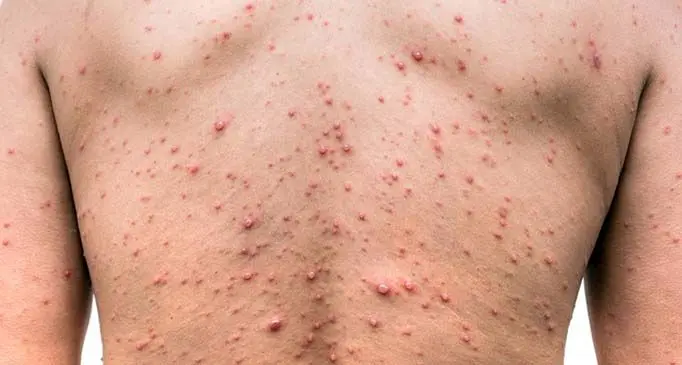 severe-chickenpox-varicella