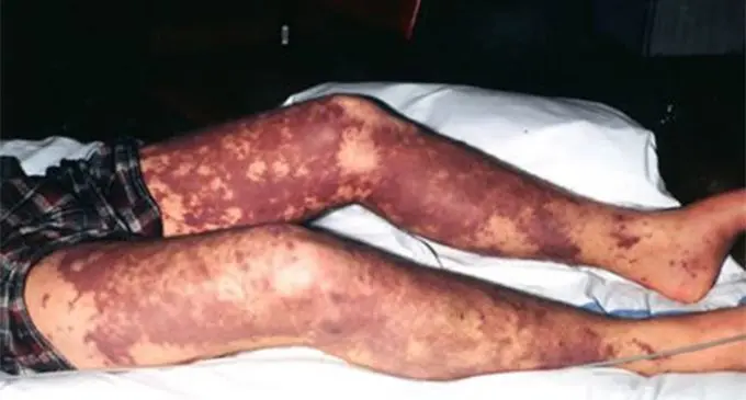 meningococcal-disease5464 copy