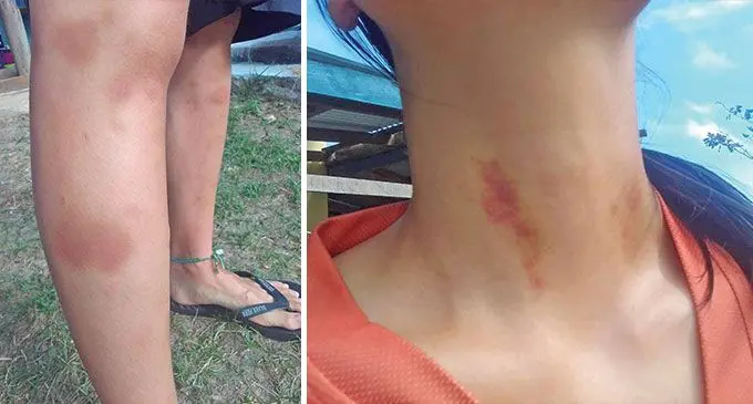 Victim shows visible bruise marks on her legs from the alleged rape.