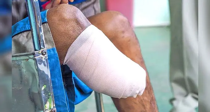 A diabetic patient is pictured after a leg amputation. Photo: Ministry of Health and Medical Services