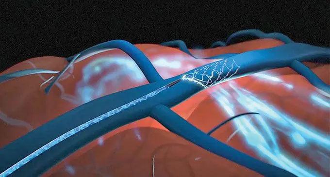 A Synchron animation explaining its brain implant. The company has regulatory approval to test a device in humans that, like Neuralink’s implant, aims to help paralyzed people type with their minds. Photo: Reuters