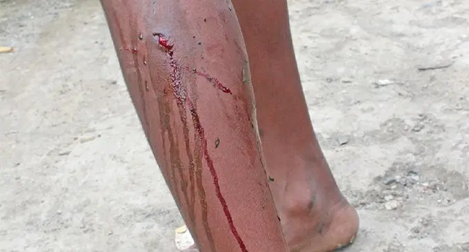 The 13-year-old boy reveals his bite marks after dog attack. Photo: Kelera Sovasiga