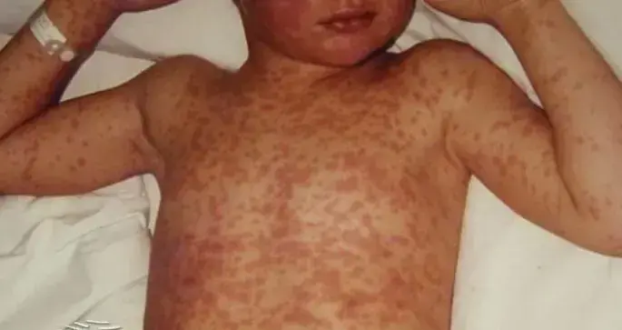 measles