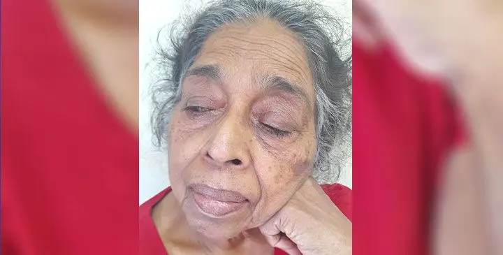 Esther Kurpuwati, claimed some swelling to her eyes. Photo: Waisea Nasokia